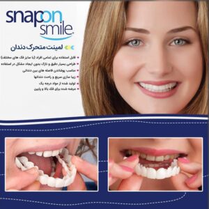 لمینت متحرک دندان Snap On Smile