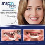 لمینت دندان متحرک، اسنپ اسمایل برای زیبایی دندانها